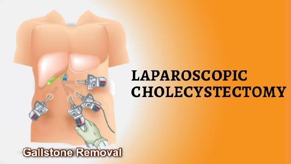 Gallstones Laparoscopic Surgery Removal