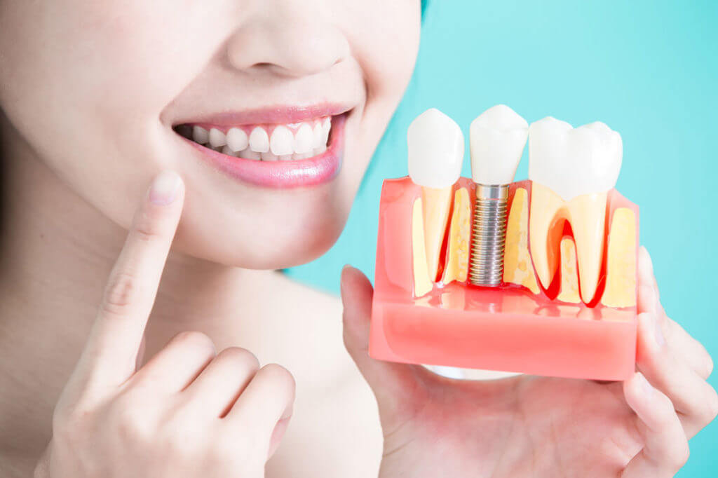 What to Eat After Dental Implants Procedure?