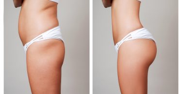 Tummy Tuck Surgery