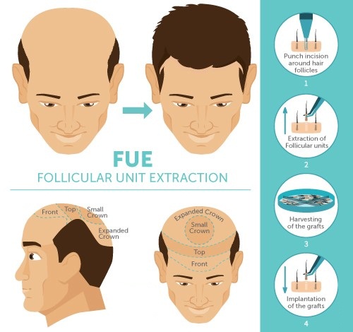 Find High-Quality FUE Hair Transplant Clinic in Delhi