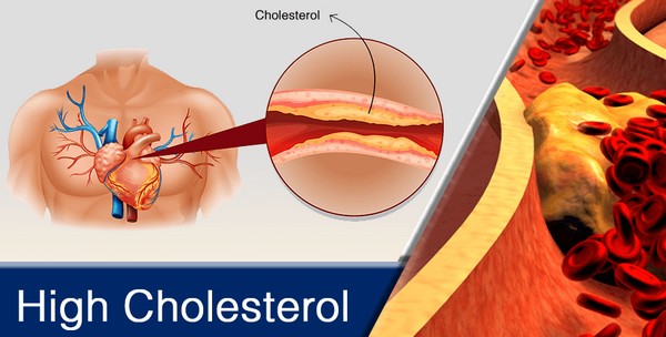 Effects of High Cholesterol on the Body