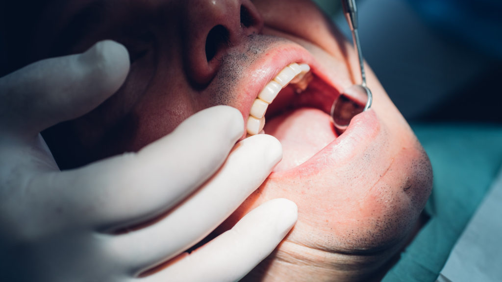 Types of Tooth Cracks