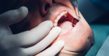 Types of Tooth Cracks