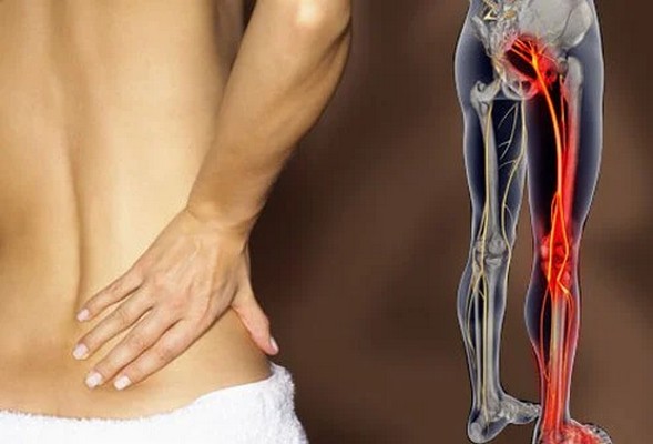 Sciatic Nerve Pain