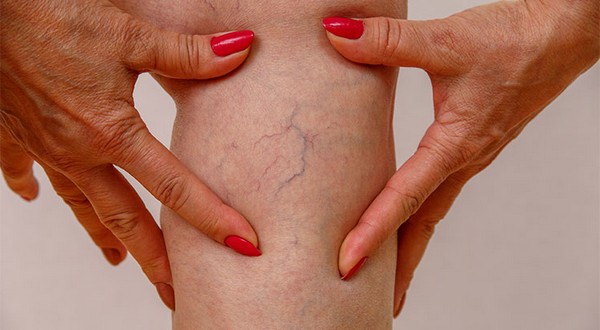 Varicose Veins