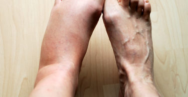 Treatments for Leg Swelling