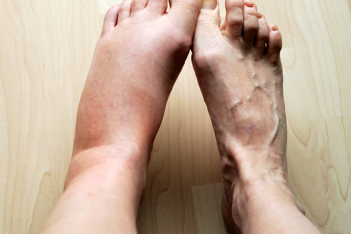 Treatments for Leg Swelling