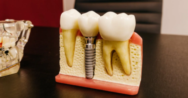 Procedure of Dental Implants