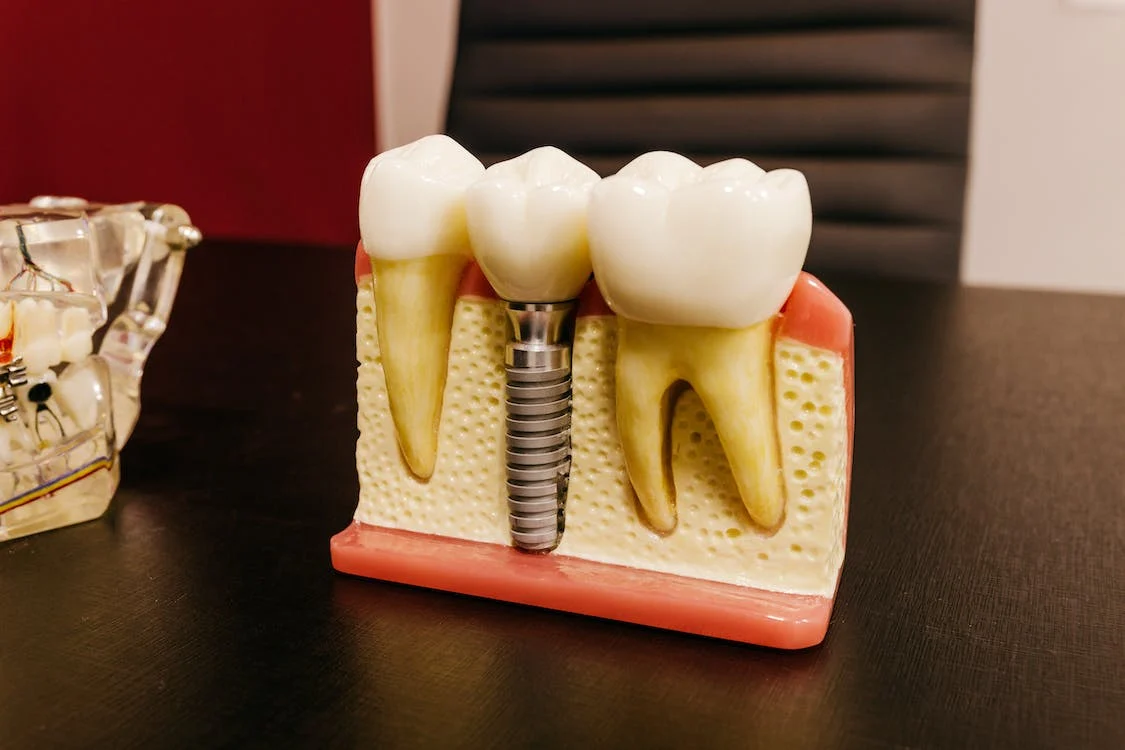 Procedure of Dental Implants