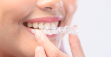 Invisalign Function