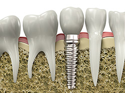 single tooth implant