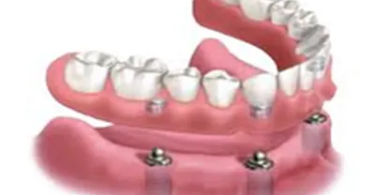 single tooth implant