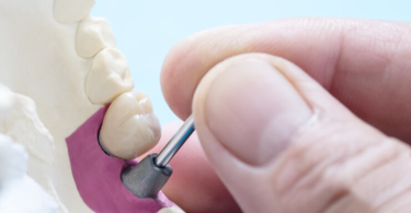 Why Need a Dental Crown