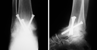 Ankle Fusion Surgery