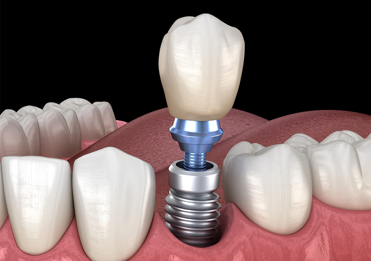 Benefits of a Single Tooth Implant