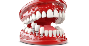 Full Mouth Implants