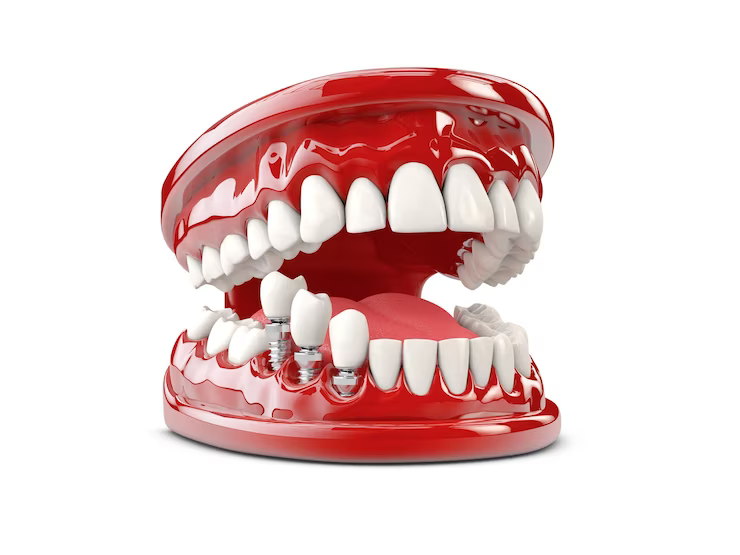 Full Mouth Implants