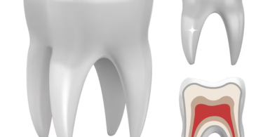 dental crowns