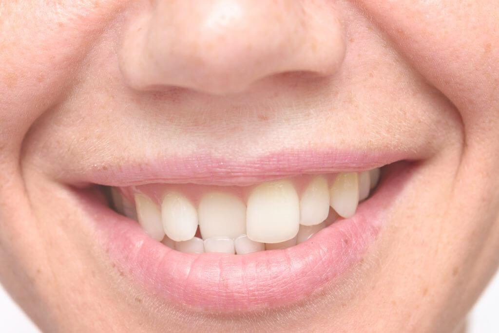 Best Treatments for Misaligned Teeth