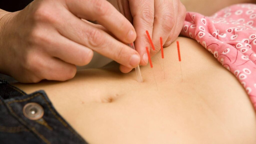 Close-up of a hand precisely placing acupuncture needles on a patient's back, illustrating the application of this traditional Chinese medicine technique for promoting natural balance and healing. 