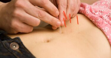 Close-up of a hand precisely placing acupuncture needles on a patient's back, illustrating the application of this traditional Chinese medicine technique for promoting natural balance and healing.