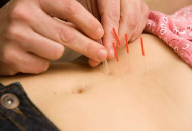 Close-up of a hand precisely placing acupuncture needles on a patient's back, illustrating the application of this traditional Chinese medicine technique for promoting natural balance and healing.